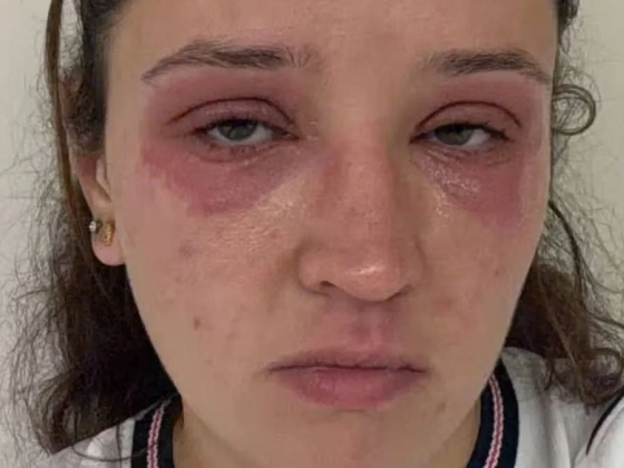 Élete legszebb napja rémálommá vált: súlyos allergiás reakció torzította el a menyasszony arcát