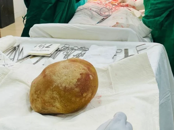 3,5 kilós követ szedtek ki egy férfi hólyagjából, aki nem vette észre, hogy kifejlett csecsemő súlyú, strucctojásnyi szikla akadályozza a vizelésben egy évtizede