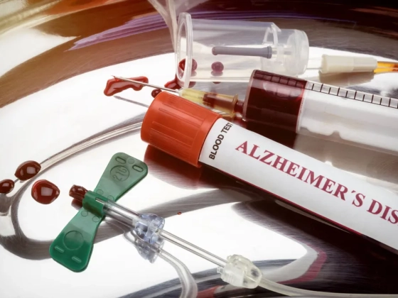 Vérátömlesztéssel is terjedhet az Alzheimer-kór?